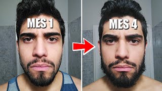 MINOXIDIL LO BUENO y LO MALO tras 4 MESES de USO 71 Tips [upl. by Sreip521]