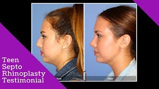 Does a septoplasty change the shape of the nose [upl. by Alatea]