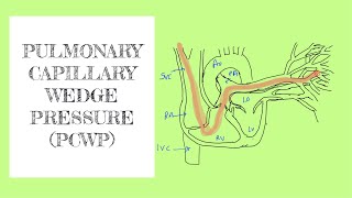 Pulmonary capillary wedge pressure PCWP [upl. by Loginov]